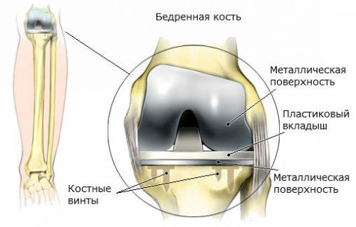 Възможни усложнения след замяна на коляното