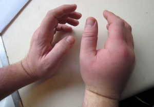 Признаци и лечение на алергичен артрит при възрастни и деца