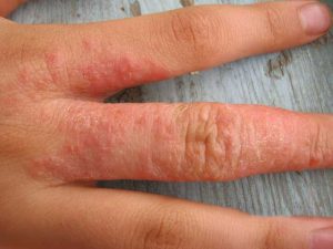 Признаци и лечение на алергичен артрит при възрастни и деца