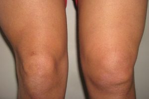 Етапи и лечение на остеоартрит на коляното