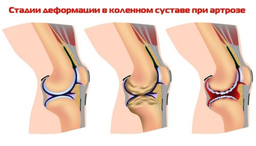 Етапи и лечение на остеоартрит на коляното