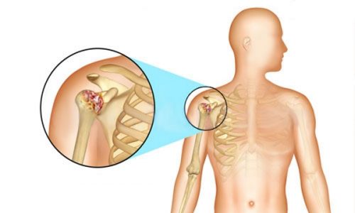 Симптоми и методи за лечение на артрит на рамото в различни форми