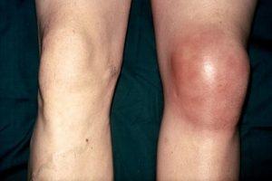 Симптоми и лечение на бурсит на колянната става