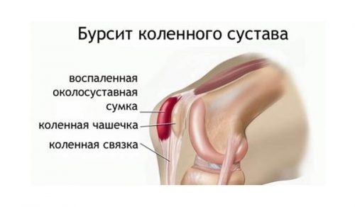 Симптоми и лечение на бурсит на колянната става