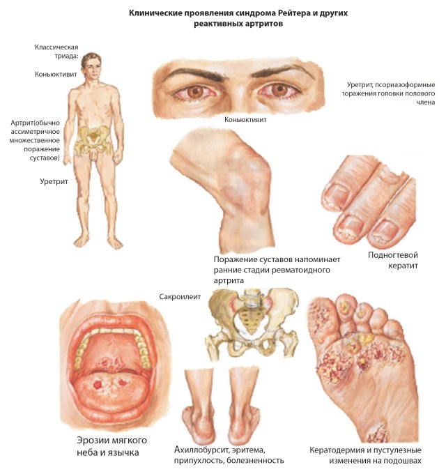 Симптоми и лечение на хламидиални артритни стави