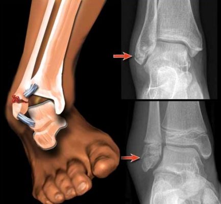 Симптоми и лечение на остеопороза на краката