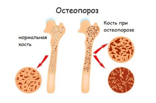 Симптоми и лечение на остеопороза на колянната става от 1-4 градуса