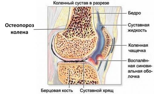Симптоми и лечение на остеопороза на колянната става от 1-4 градуса