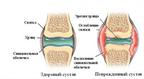 Симптоми на синовит на колянната става и методи за нейното лечение