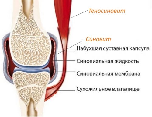 Симптоми на синовит на колянната става и методи за нейното лечение