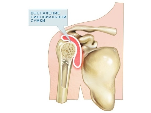 Симптоми на синовит на рамото и начини за лечение