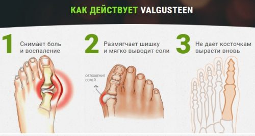 Ефективността на Valgusteen гел от конуси върху крака