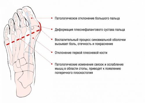 Лазерният метод за отстраняване на конуса на краката