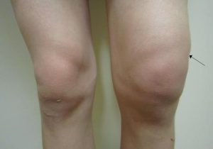 Използване на медицинска жлъчка с артроза на колянната става