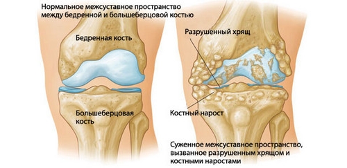 Използването на nyxes с артроза на колянната става