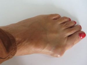 Лечение на артроза на ставите на краката