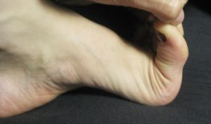 Лечение на конуси по краката на палеца