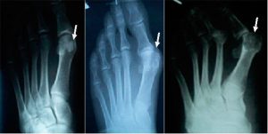 Лечение на конуси по краката на палеца
