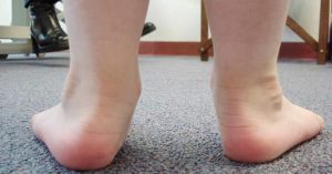 Лечение на плоска деформация на краката при деца