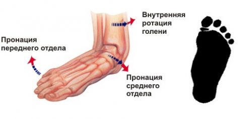 Лечение на плоска деформация на краката при деца