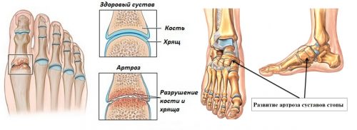 Лечение на артроза на крака в дома