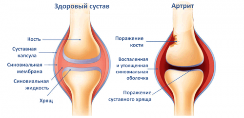 Лечение на артрит на колянната става у дома