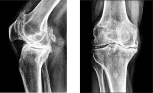 Лечение на полиартрит на колянната става