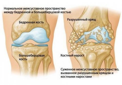 Лечение на полиартрит на колянната става