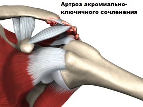 Лечение на остеоартроза на раменната става от 1, 2 и 3 градуса