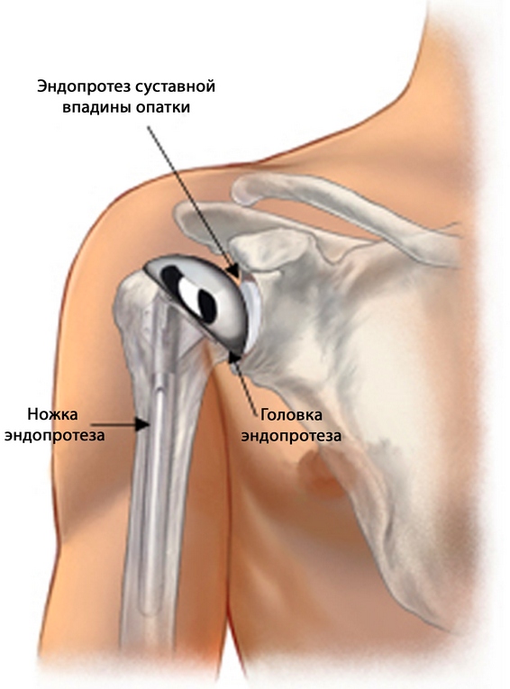 Лечение на остеоартроза на раменната става от 1, 2 и 3 градуса