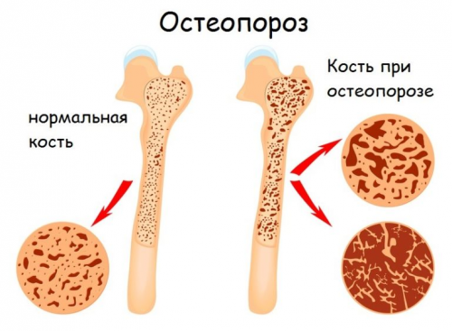 Лечение на остеопороза у дома
