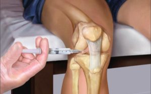 Лечение на пателофрамална артроза на колянната става