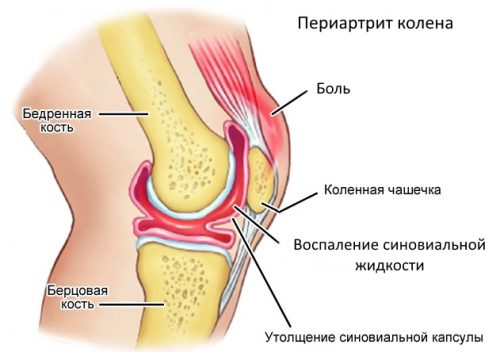 Лечение на периартрит на колянната става и нейните симптоми