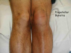 Лечение на пред-пателарен бурсит на колянната става