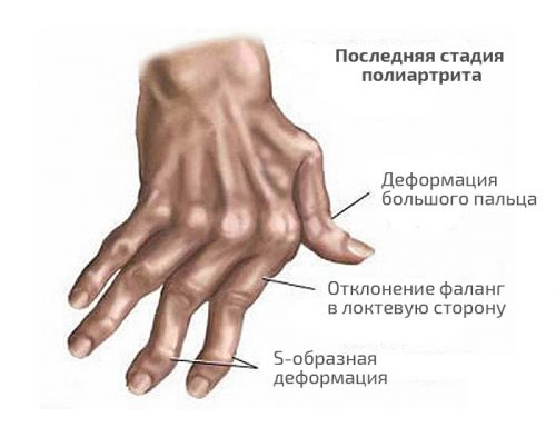 Артрит на пръстите на ръцете: първите симптоми и лечение на ревматоиден заболявания