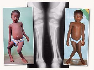 Лечение на валгус кривина на краката при дете