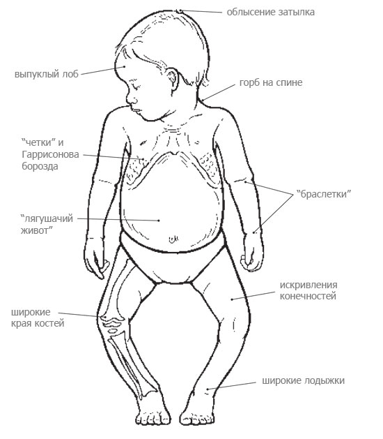 Лечение на деформация на варус в долните крайници при деца