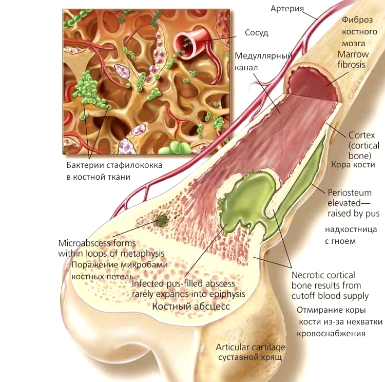 Видове хематогенен остеомиелит и признаци на лечение
