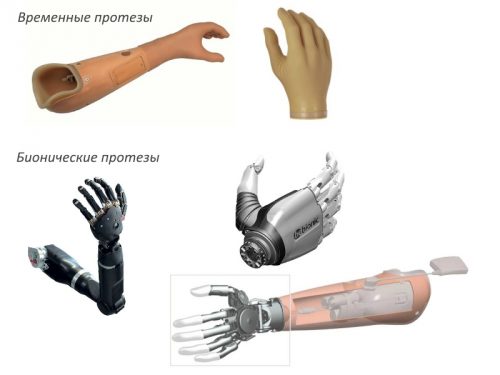 Видове продукти за протезиране на ръката