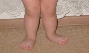 Валгус деформация на колената: причини, симптоми, лечение