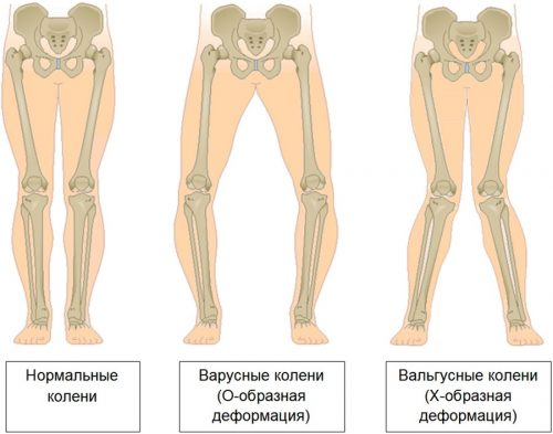 Валгус деформация на колената: причини, симптоми, лечение