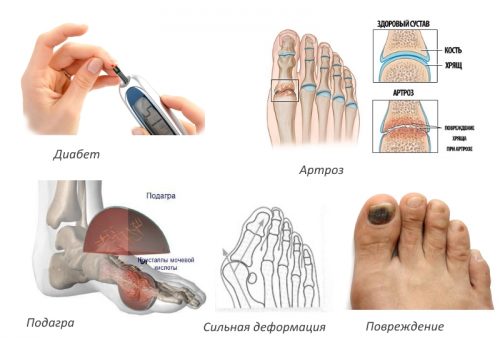 Valgus Pro - ортопедичен фиксатор на големия пръст