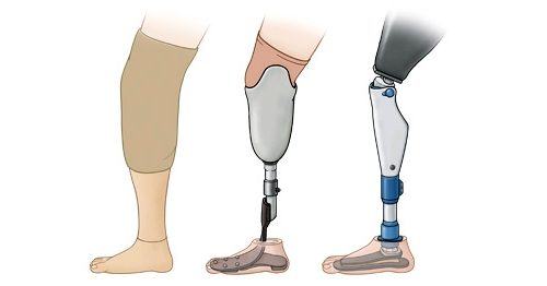 Избираме модерни протези за долните крайници