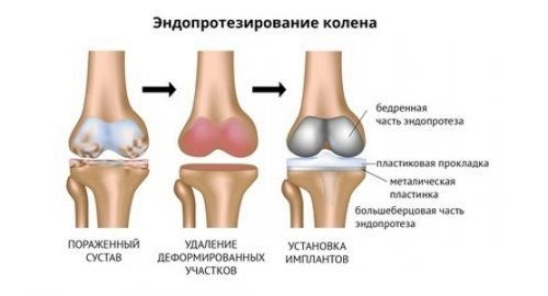 Избираме ендопротезата на колянната става