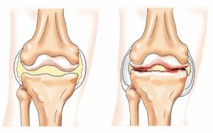 Какви са остеофитите на колянната става и как да се лекувате с тях?
