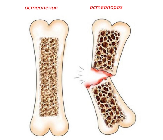 Каква е разликата между остеопорозата и остеопенията?