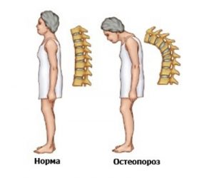 Какво представлява дифузната остеопороза?