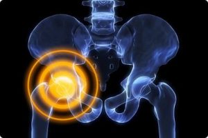 Какво представлява остеоартритът и как да го лекуваме?