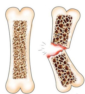 Какво представлява остеопорозата и как да се лекува?
