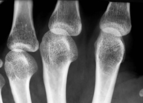 Какво представлява остеопорозата и как да се лекува?